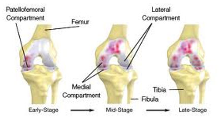 Stages-of-Osteoarthritis