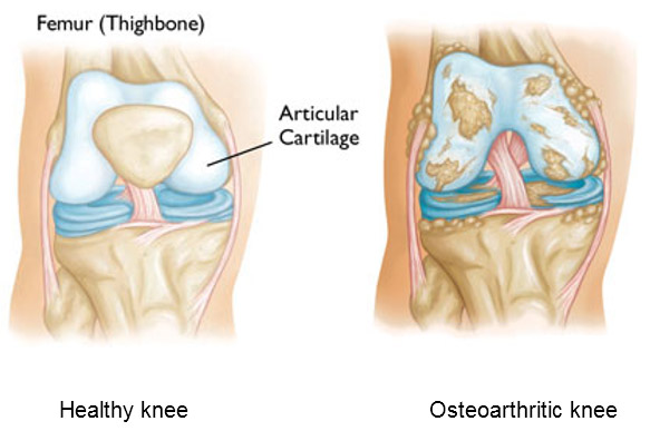 What-is-Osteoarthritis